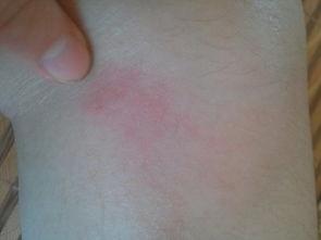 跳蚤咬的图片,揭秘常见家居害虫的侵扰